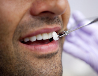 Veneers